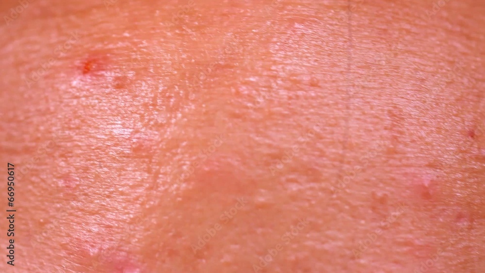 Close up of Acne skin because the disorders Of sebaceous glands Close up of Acne skin because the disorders Of sebaceous glands