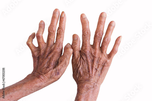 Canvastavla hands of a leprosy isolated on white background