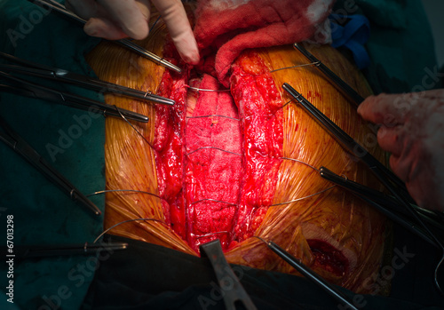 Bilde på lerret closure sternum bone with metal wires
