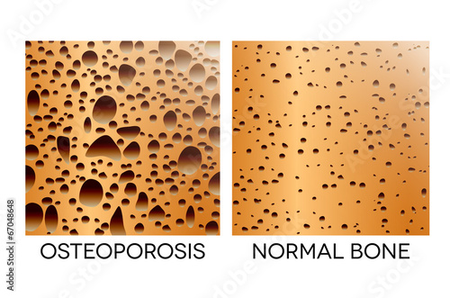 Osteoporosis, unhealthy bone and healthy bone