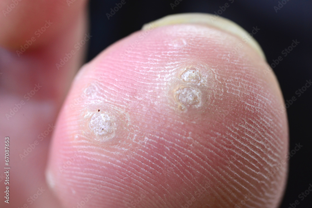 Fototapeta premium 足のたこ