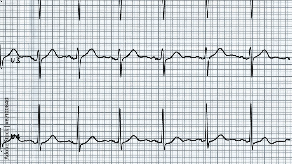 Electrocardiography of heart beat Electrocardiography of heart beat