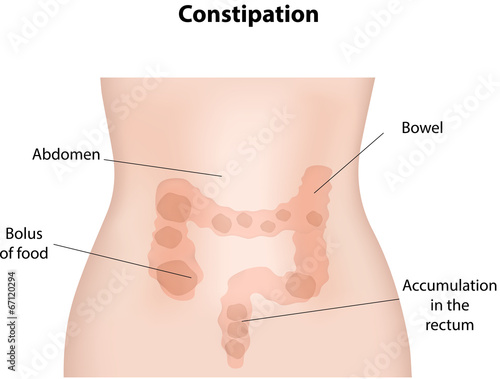 Constipation
