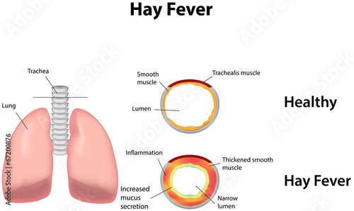 Hay Fever