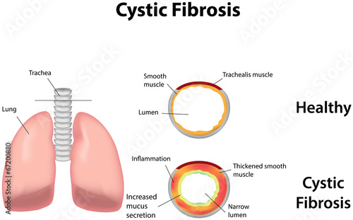 Cystic Fibrosis