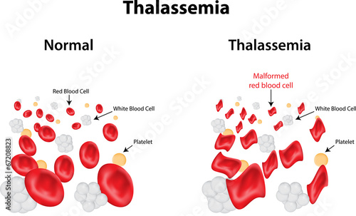 Thalassaemia