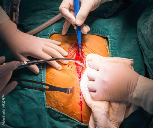 Принти на полотні median sternotomy incision