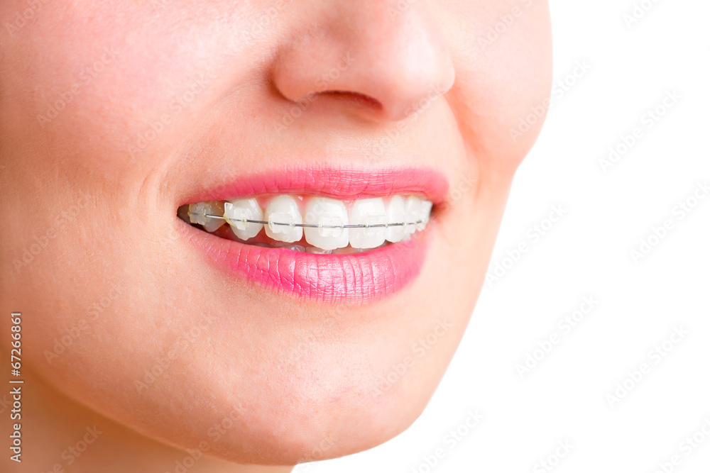 Braces Braces
