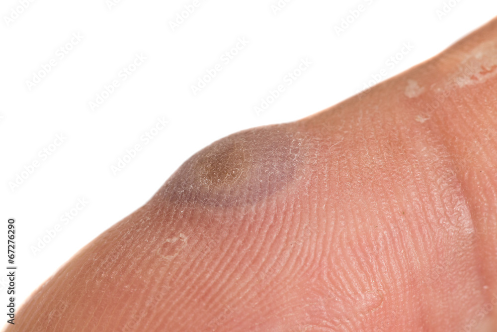 Fototapeta premium verruca and blister after being frozen