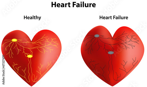 Heart Failure Diagram
