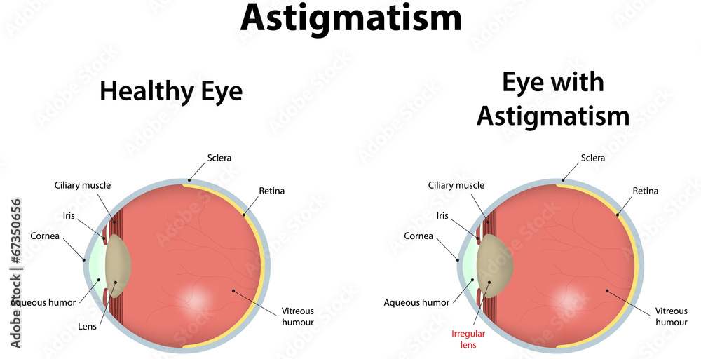 Astigmatism - obrazy, fototapety, plakaty 