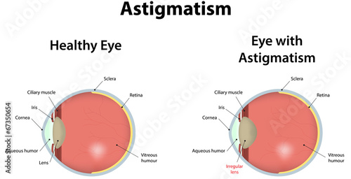 Tableau sur toile Astigmatism