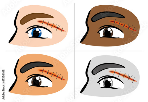First Aid suture wound eyebrow
