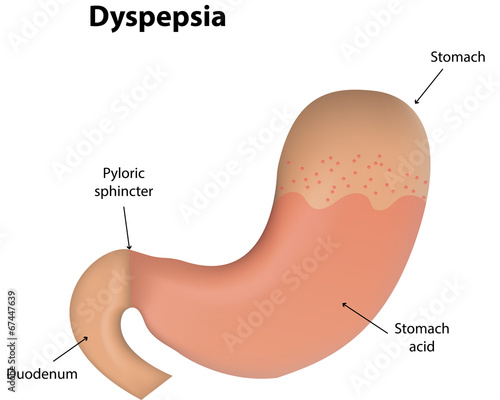 Dyspepsia