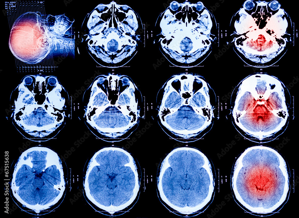 X-Ray scan human for brain