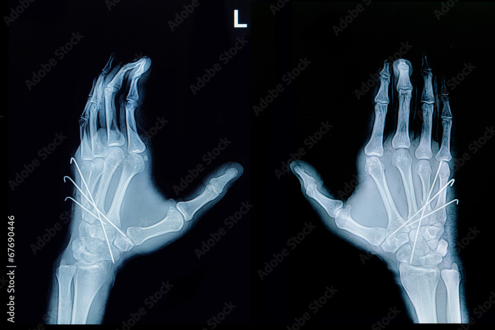 Fototapeta premium Film x-ray of hand fracture : show fracture metacarpal bone inse