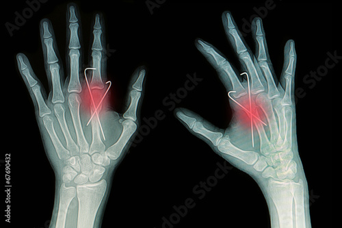 Film x-ray of hand fracture: fracture metacarpal bone photo