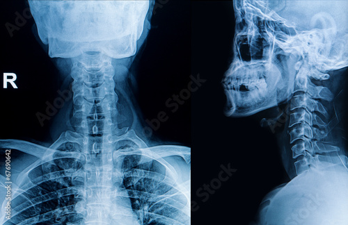 X-ray hand and finger injury