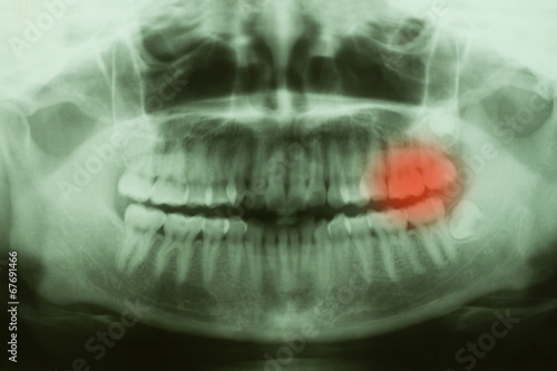 Panoramic dental X-Ray with red painful area