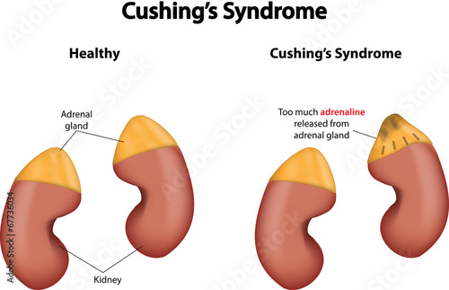 Cushing's Syndrome photo