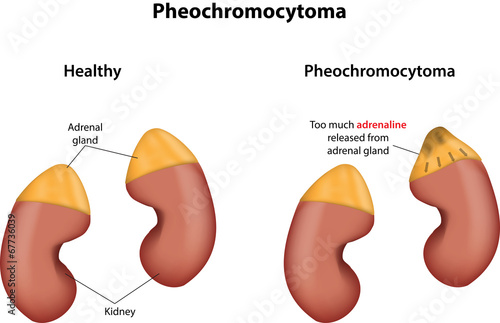 Pheochromocytoma