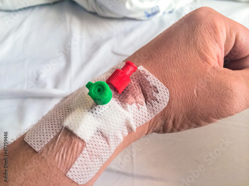 Intravenous cannula, Venflon