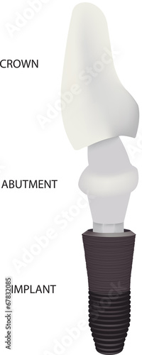 impianto dente