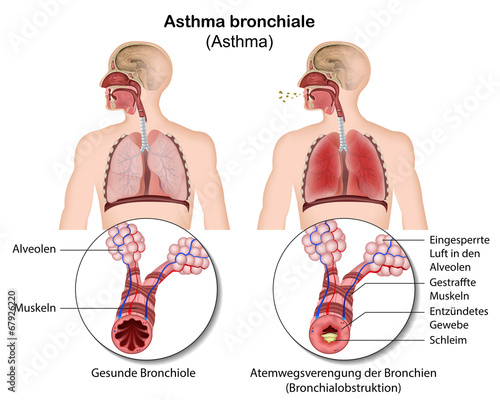 Asthma bronchiale, Bronchokonstriktion Illustration photo