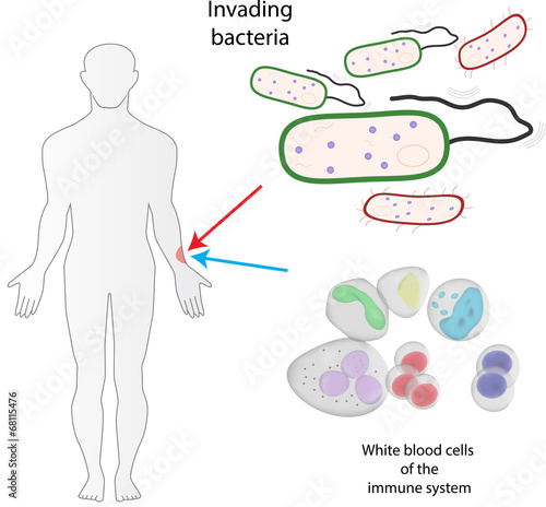 Bacterial Infection