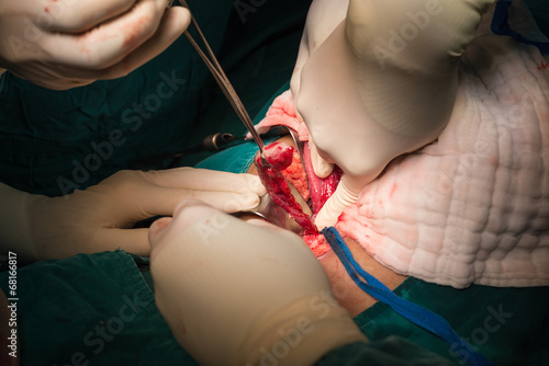 ligation appendix for appendectomy photo