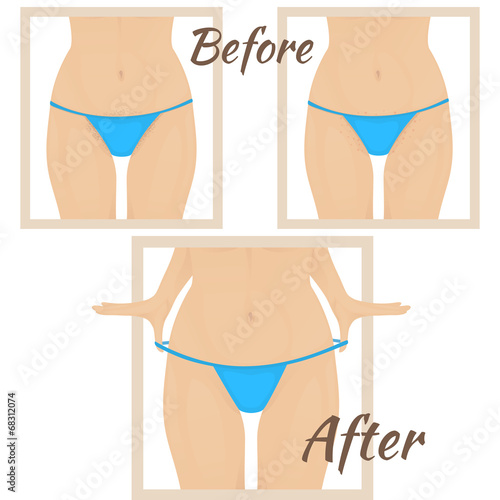 hair removal