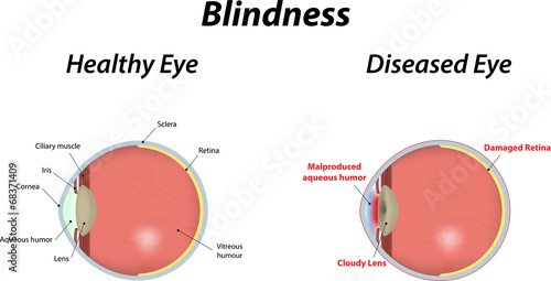 Blindness