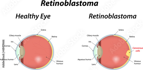 Retinoblastoma