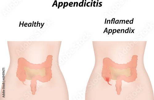 Appendicitis