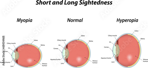 Short and Long Sighted