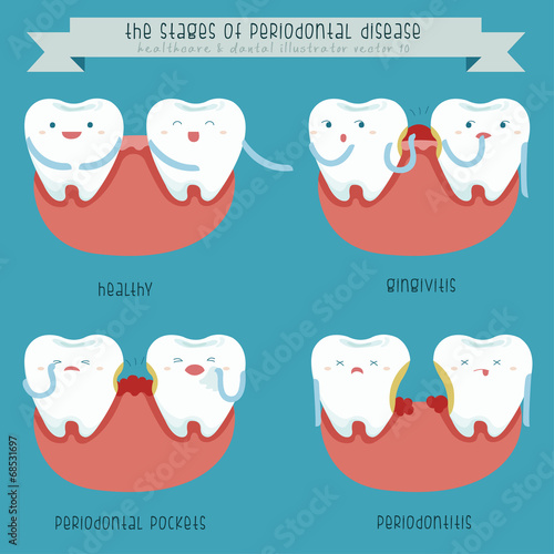 The stages of periodontal disease