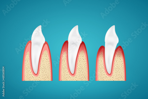 Stages progress disease gum on human canine