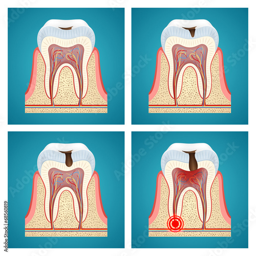 Stages progress dental caries and toothache