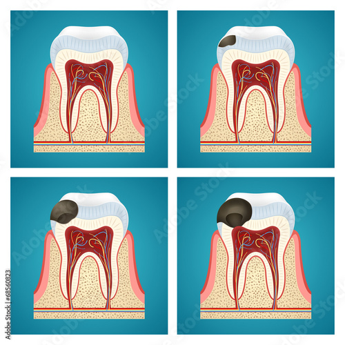 Stages progress caries on human teeth