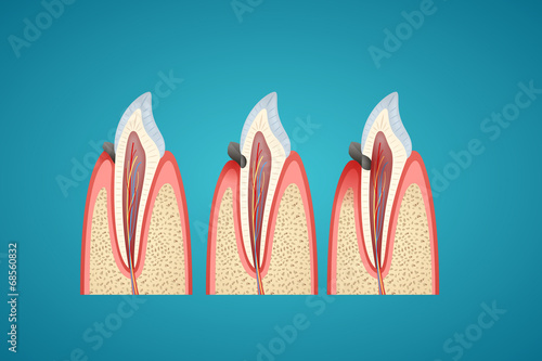 Stages progress caries on human canine