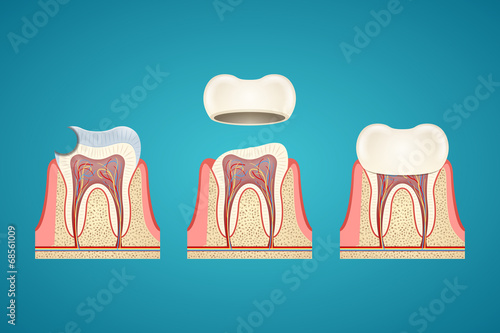 Breaking teeth