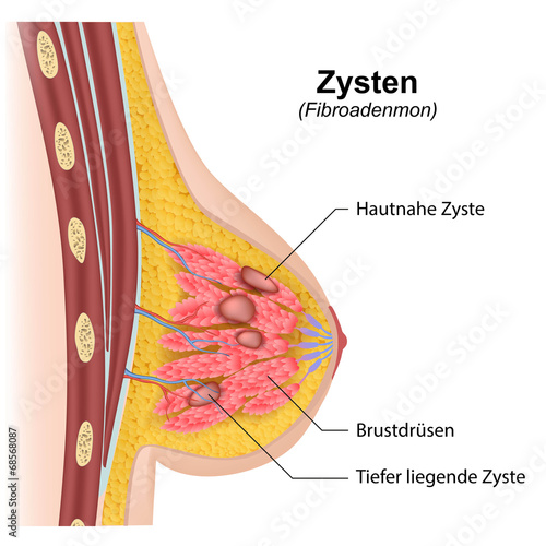 Zysten in der Brust, Fibroadenmon