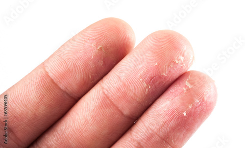 Closeup of Eczema Dermatitis on Back of Fingers © showcake
