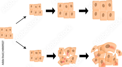 Cancer Progression
