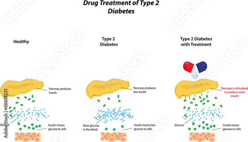 Drug Treatment of Type 2 Diabetes photo