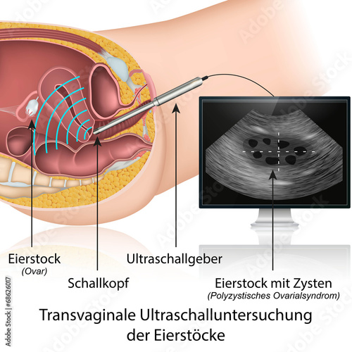 Transvaginale Ultraschalluntersuchung der Eierstöcke