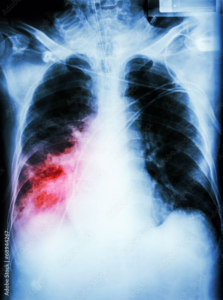 Pneumonia with respiratory failure Pneumonia with respiratory failure
