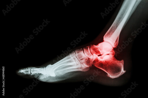 Schilderij op canvas Arthritis at ankle joint (Gout , Rheumatoid arthritis)