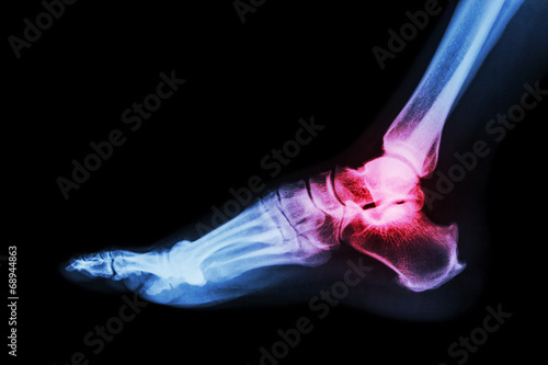 Arthritis at ankle joint (Gout , Rheumatoid arthritis)