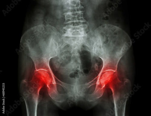 x-ray pelvis of osteoporosis patient and arthritis both hip